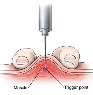 dryneedling google image