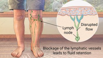 Lymphedema Image